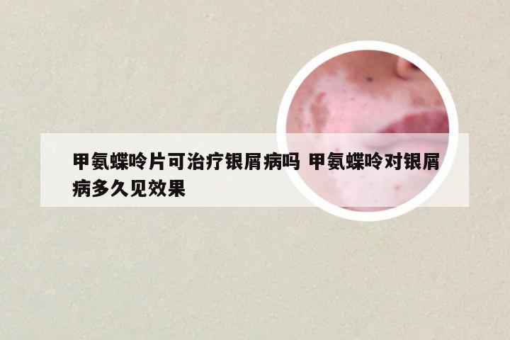 甲氨蝶呤片可治疗银屑病吗 甲氨蝶呤对银屑病多久见效果