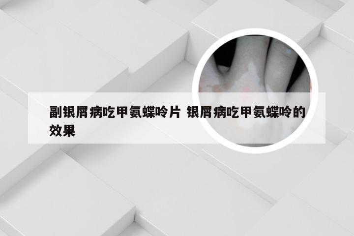 副银屑病吃甲氨蝶呤片 银屑病吃甲氨蝶呤的效果