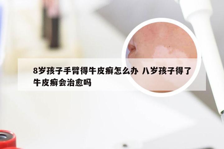 8岁孩子手臂得牛皮癣怎么办 八岁孩子得了牛皮癣会治愈吗