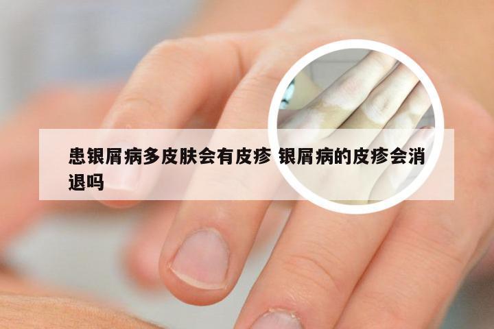 患银屑病多皮肤会有皮疹 银屑病的皮疹会消退吗