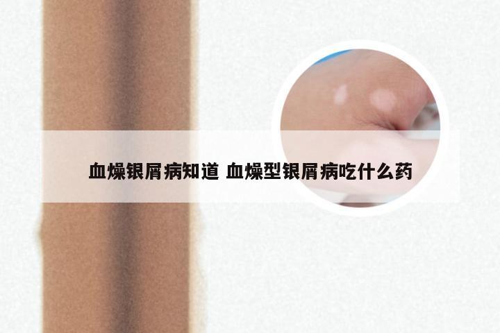 血燥银屑病知道 血燥型银屑病吃什么药