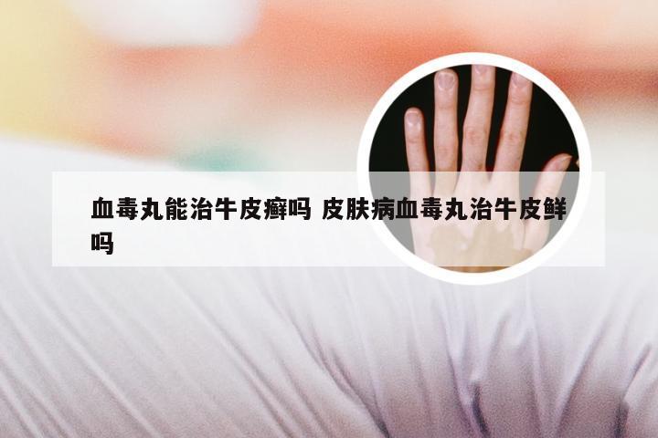 血毒丸能治牛皮癣吗 皮肤病血毒丸治牛皮鲜吗