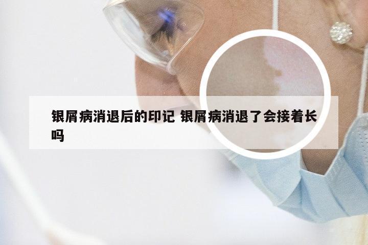 银屑病消退后的印记 银屑病消退了会接着长吗
