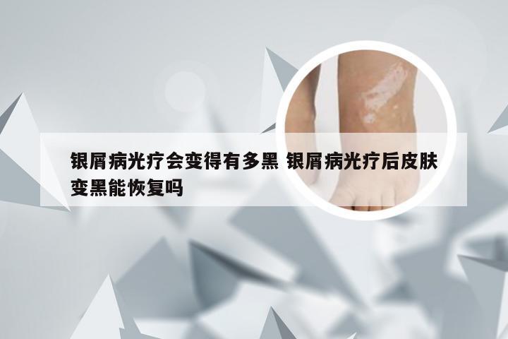 银屑病光疗会变得有多黑 银屑病光疗后皮肤变黑能恢复吗