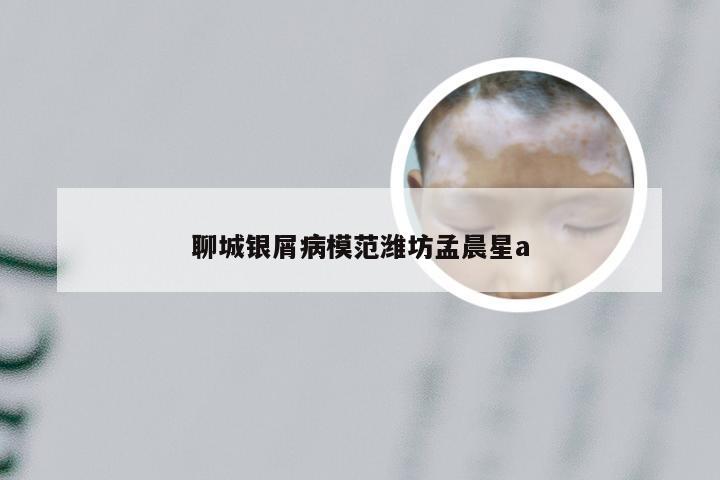 聊城银屑病模范潍坊孟晨星a