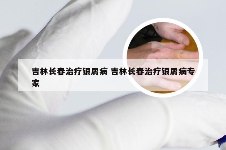 吉林长春治疗银屑病 吉林长春治疗银屑病专家