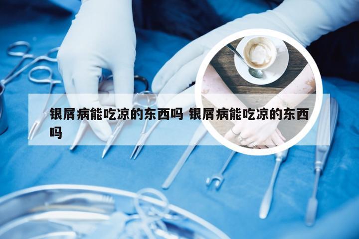 银屑病能吃凉的东西吗 银屑病能吃凉的东西吗