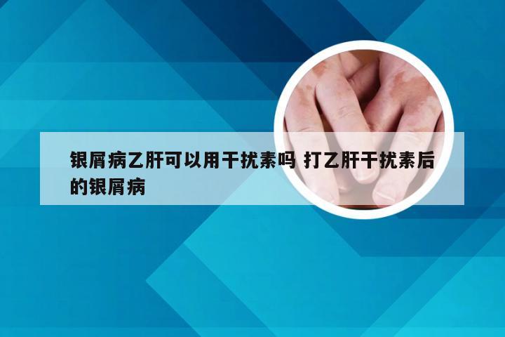 银屑病乙肝可以用干扰素吗 打乙肝干扰素后的银屑病
