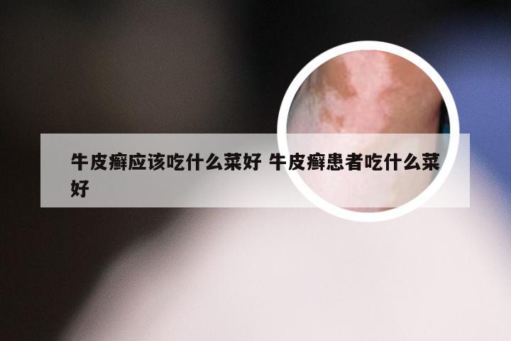牛皮癣应该吃什么菜好 牛皮癣患者吃什么菜好