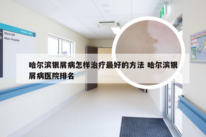 哈尔滨银屑病怎样治疗最好的方法 哈尔滨银屑病医院排名
