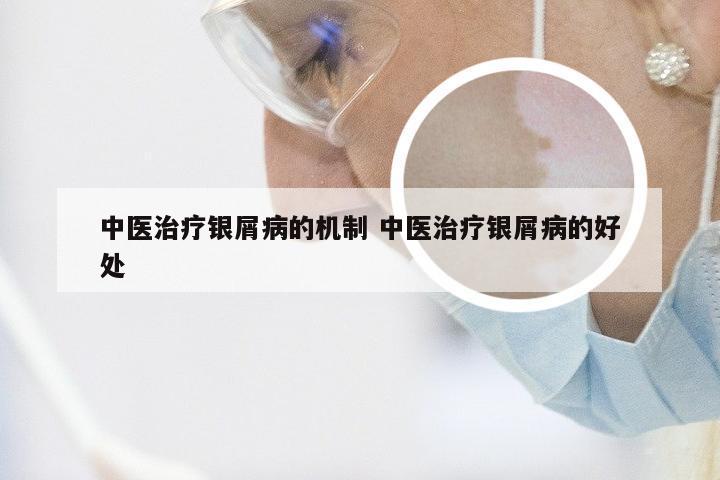 中医治疗银屑病的机制 中医治疗银屑病的好处