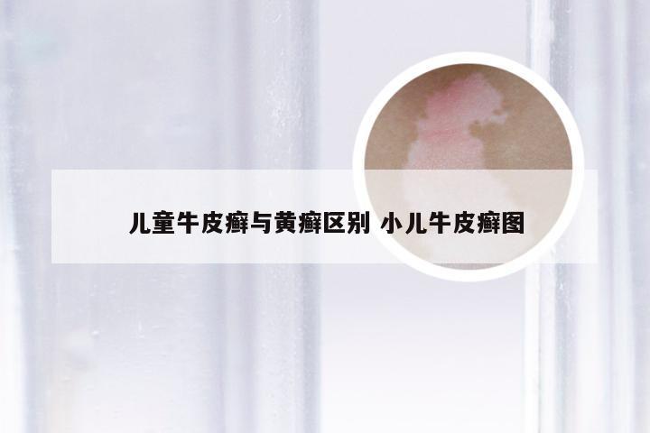 儿童牛皮癣与黄癣区别 小儿牛皮癣图