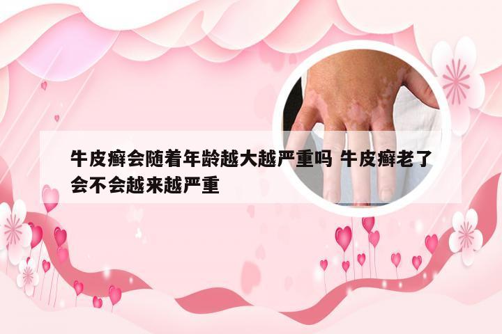 牛皮癣会随着年龄越大越严重吗 牛皮癣老了会不会越来越严重