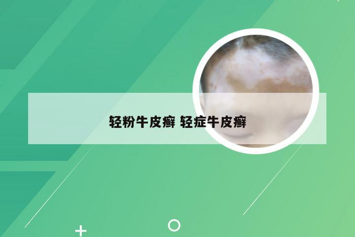 轻粉牛皮癣 轻症牛皮癣