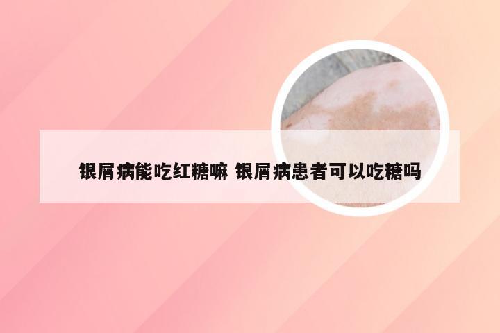 银屑病能吃红糖嘛 银屑病患者可以吃糖吗