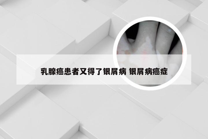 乳腺癌患者又得了银屑病 银屑病癌症
