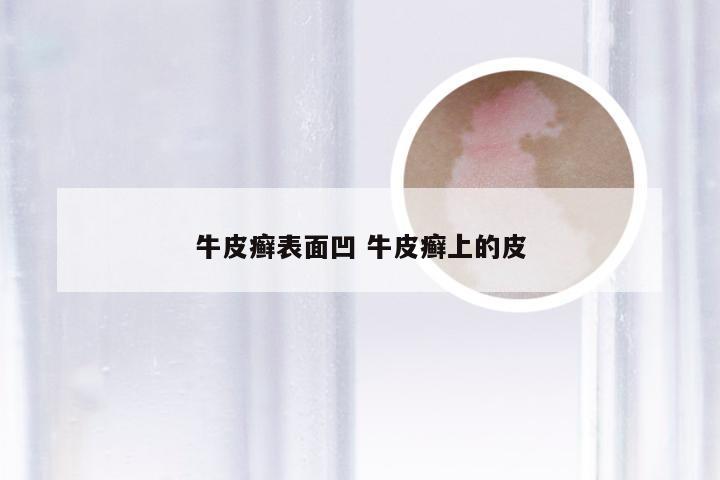 牛皮癣表面凹 牛皮癣上的皮
