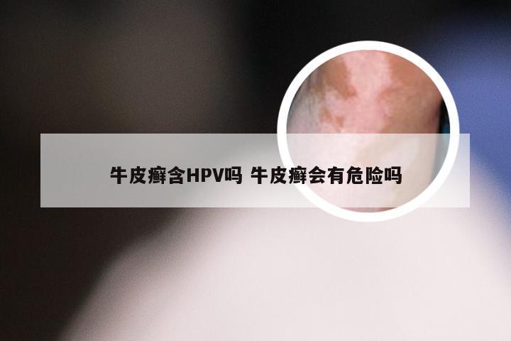 牛皮癣含HPV吗 牛皮癣会有危险吗