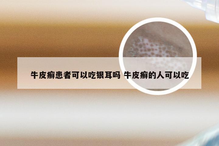 牛皮癣患者可以吃银耳吗 牛皮癣的人可以吃