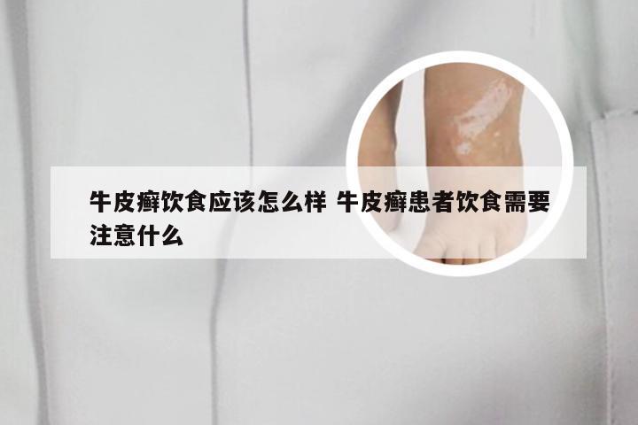 牛皮癣饮食应该怎么样 牛皮癣患者饮食需要注意什么
