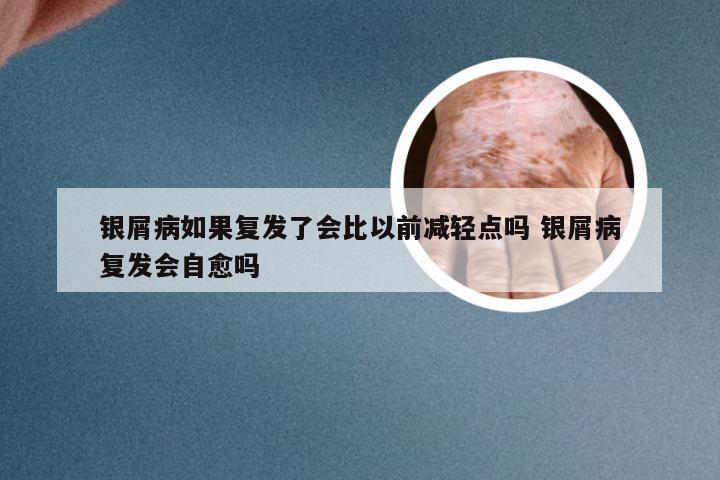 银屑病如果复发了会比以前减轻点吗 银屑病复发会自愈吗