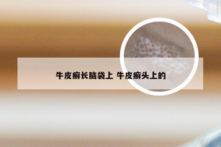 牛皮癣长脑袋上 牛皮癣头上的