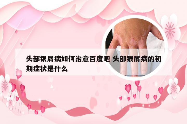 头部银屑病如何治愈百度吧 头部银屑病的初期症状是什么