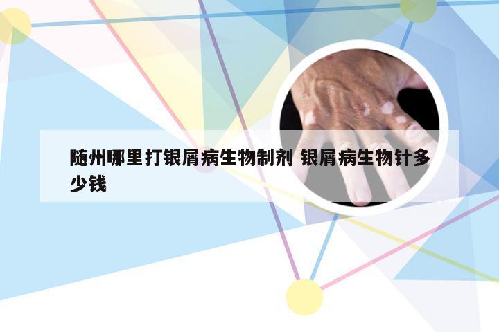 随州哪里打银屑病生物制剂 银屑病生物针多少钱