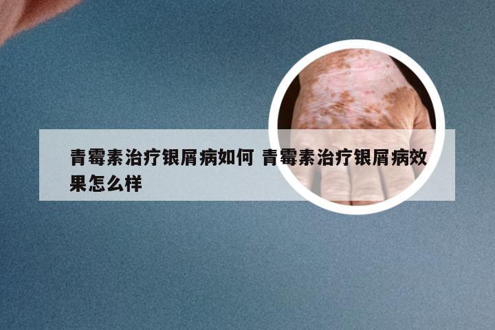 青霉素治疗银屑病如何 青霉素治疗银屑病效果怎么样