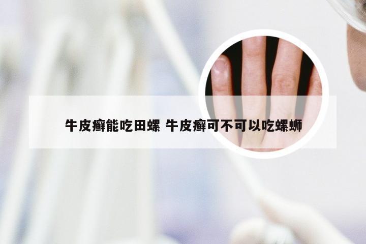 牛皮癣能吃田螺 牛皮癣可不可以吃螺蛳