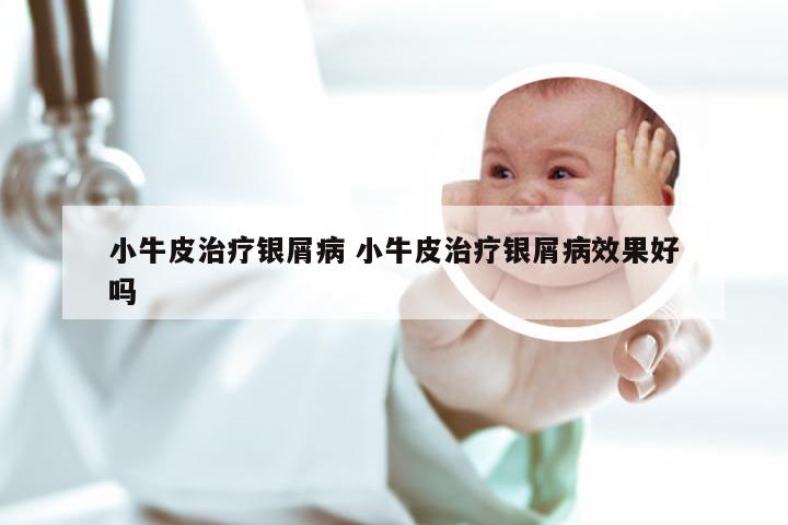 小牛皮治疗银屑病 小牛皮治疗银屑病效果好吗
