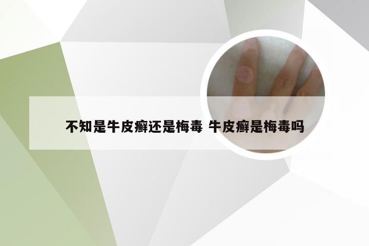 不知是牛皮癣还是梅毒 牛皮癣是梅毒吗