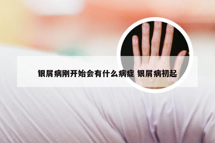 银屑病刚开始会有什么病症 银屑病初起