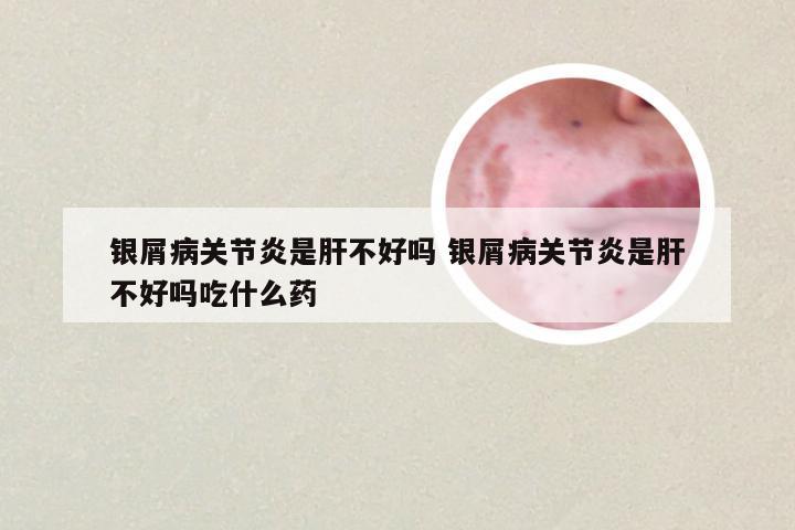 银屑病关节炎是肝不好吗 银屑病关节炎是肝不好吗吃什么药