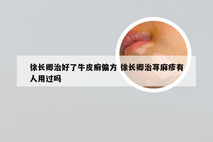 徐长卿治好了牛皮癣偏方 徐长卿治荨麻疹有人用过吗