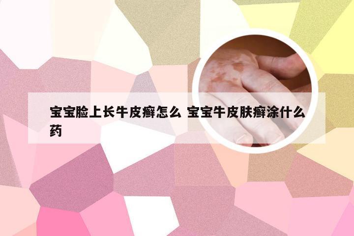 宝宝脸上长牛皮癣怎么 宝宝牛皮肤癣涂什么药