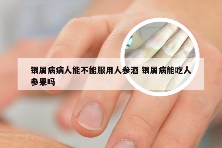 银屑病病人能不能服用人参酒 银屑病能吃人参果吗