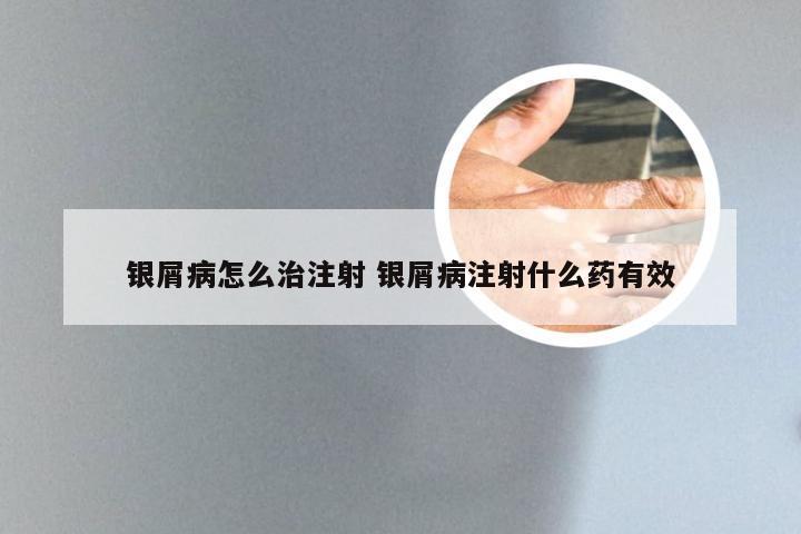 银屑病怎么治注射 银屑病注射什么药有效