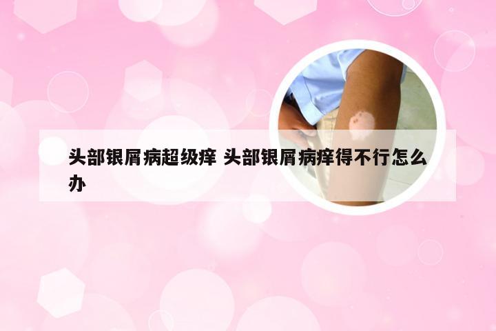头部银屑病超级痒 头部银屑病痒得不行怎么办