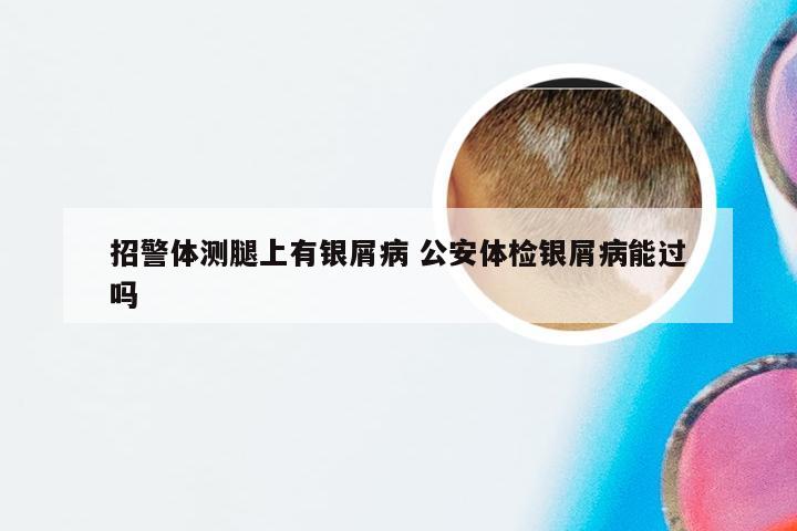 招警体测腿上有银屑病 公安体检银屑病能过吗