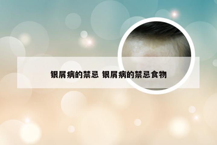 银屑病的禁忌 银屑病的禁忌食物