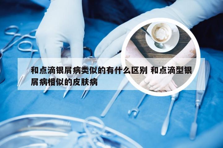 和点滴银屑病类似的有什么区别 和点滴型银屑病相似的皮肤病