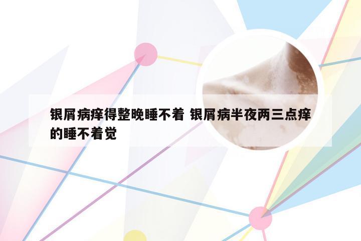 银屑病痒得整晚睡不着 银屑病半夜两三点痒的睡不着觉