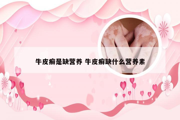 牛皮癣是缺营养 牛皮癣缺什么营养素