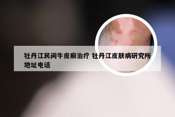 牡丹江民间牛皮癣治疗 牡丹江皮肤病研究所地址电话