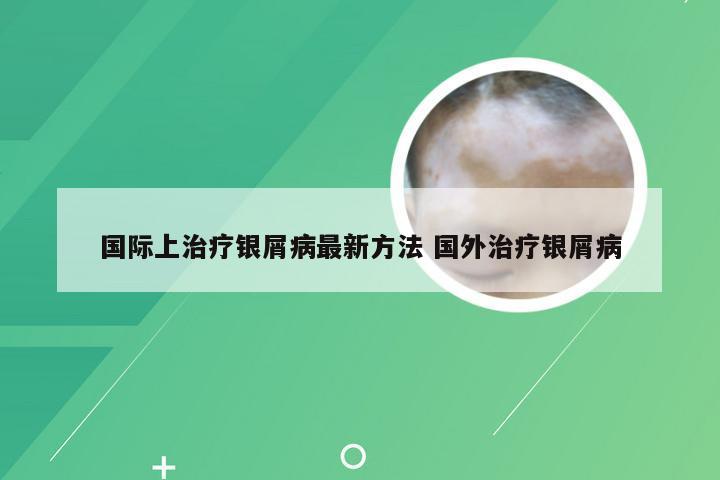 国际上治疗银屑病最新方法 国外治疗银屑病