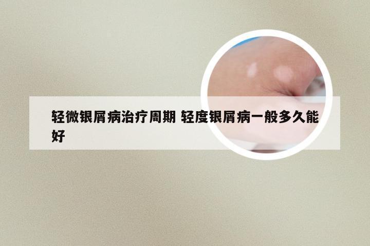 轻微银屑病治疗周期 轻度银屑病一般多久能好