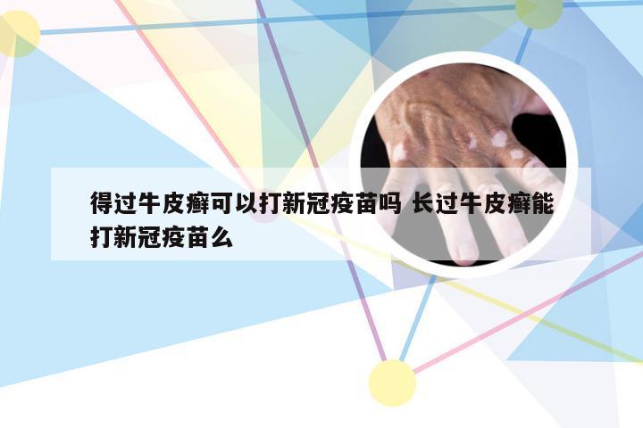 得过牛皮癣可以打新冠疫苗吗 长过牛皮癣能打新冠疫苗么