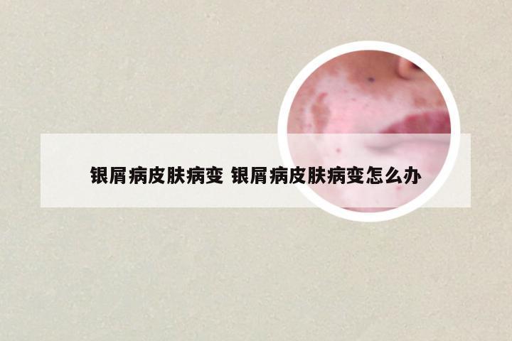 银屑病皮肤病变 银屑病皮肤病变怎么办