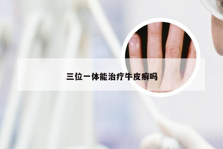 三位一体能治疗牛皮癣吗